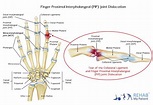 Finger Proximal Interphalangeal (PIP) Joint Dislocation | Rehab My Patient