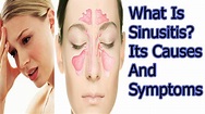 what is Sinusitis? Its Causes And Symptoms - YouTube