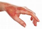 A Guide to Treating your Burn or Scald - First Aid for Life