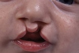 Cleft lip and palate - NHS