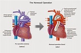 Twitter पर MediGence: "Norwood procedure for Hypoplastic Left Heart ...