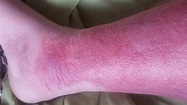 BubbaMike's Ramblings: Cellulitis (warning, graphic photos in this post)