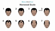 The Norwood scale: Understanding the stages of balding