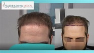 Power of the "Frontal Band" | Hairline Hair Transplant Repair | Feller ...