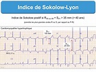 Indice d’HVG : 2. Sokolow-Lyon : e-cardiogram