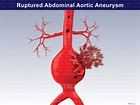 Ruptured Abdominal Aortic Aneurysm - Trial Exhibits Inc.