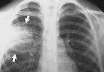 Pneumonia Lobar — Atlas Virtual e Interativo de Morfologia Geral e Especial
