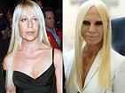 Donatella Versace before and after plastic surgery 04 | Celebrity ...
