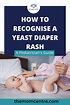 how to recognize and treat yeast diaper rash at home? - the mom centre