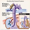 Kidshealth: Hypoplastic Left Heart Syndrome Surgery: The Norwood ...