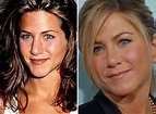 Jennifer Aniston Plastic Surgery: Before and After Pictures