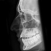 Nasal Fractures - Sports Medicine Review