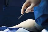 What It Means to Excise Something During Surgery