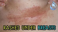 Home remedies to treat the rashes under the breasts - YouTube