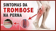 Sintomas da trombose na perna - YouTube