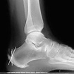 (PDF) Calcaneus Exostectomy and Achilles Tendon Reattachment for the ...