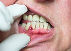 Dental Abscess - Brisbane City Dentist