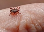 Rocky Mountain Spotted Fever During Pregnancy - The Pulse