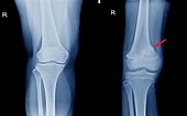 Vistas de rodilla de rayos x (ap) que muestran la articulación normal ...
