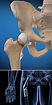 Fractura de Cadera | Grupo médico ortopédico de la costa central