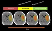 Ischemic penumbra | STROKE MANUAL