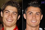 Veja o antes e o depois dos dentes dos famosos