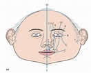 Craniofacial Clefts - Classification, Illustrations, Examples.