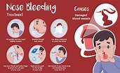 Nosebleeds (Epistaxis) in Children: Causes, Risk Factors, and How to ...