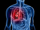 Los síntomas del cáncer de pulmón: toma nota
