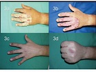 What Do 1st, 2nd and 3rd Degree Burns Look Like? A Visual Guide | Allure