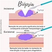 Biopsia Excisional E Incisional - EDULEARN