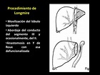 PPT - LESIONES QUIRÚRGICAS DE VÍA BILIAR PowerPoint Presentation, free ...