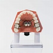 Banded and Bonded Expanders - Appliances for Widening the Upper Jaw