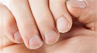 Padrastros en las uñas: ¿a qué se debe el nombre de esta lesión en las ...
