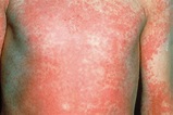 Scarlet Fever - Causes, Symptoms, Long Term Effects, Treatment