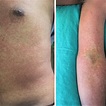 Morbilliform rash was the commonest presentation of rash | Download ...