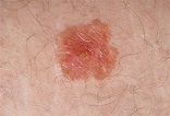Pictures of skin cancer: Skin cancer photos early stages