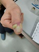 甲溝炎 (Paronychia) – 肌膚親清—陳文國醫師的5分鐘皮膚專欄