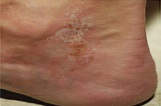 Successful Treatment of a Scleroderma-Associated Leg Ulcer W ...