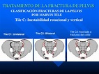 PPT - TRATAMIENTO DE LA FRACTURA DE PELVIS PowerPoint Presentation ...