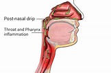 Post-nasal drip - Wikipedia