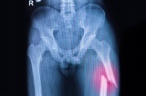 What is a femur shaft fracture (broken thighbone)? | OrthoIndy Blog