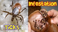 Ticks Infestation Ticks in Humans and Animals - YouTube