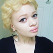 10 Stunning Photos of Black Albinos from the #InMySkinIWin Campaign ...