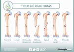 Fracturas óseas: Qué es, causas, síntomas, tratamiento y consejos ...