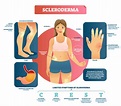 scleroderma - Arthritis Research | Arthritis National Research Foundation