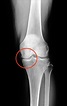 膝關節軟骨磨損 MRI精密檢查受損程度 - 自由健康網