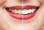 How to get whiter teeth: Four top tips to help achieve a brighter smile ...