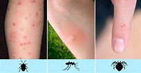 8 picaduras comunes de insectos que puedes identificar fácilmente y ...