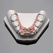 What is the Schwarz Palate Expander Appliance?
